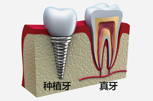 种植牙